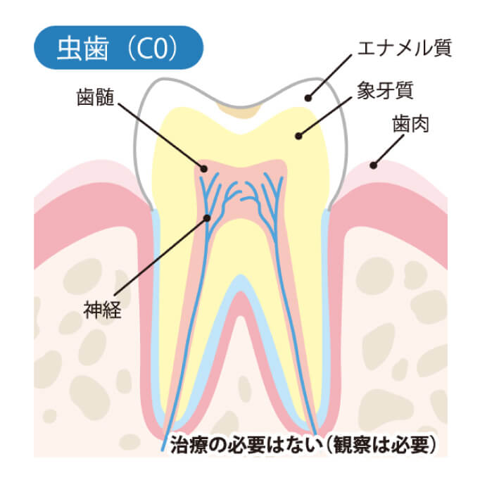 虫歯（C0）治療の必要はない（観察は必要）