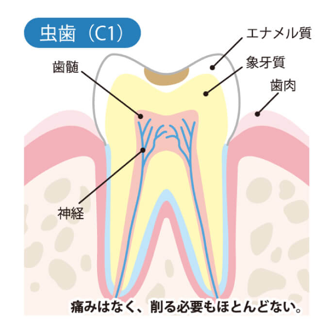 虫歯（C1）痛みはなく、削る必要もほとんどない。