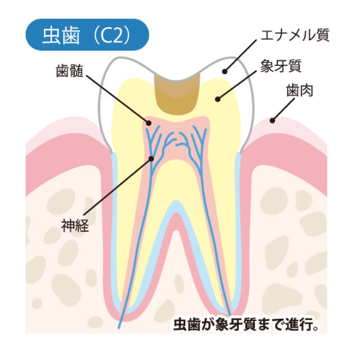 虫歯（C2）虫歯が象牙質まで進行。