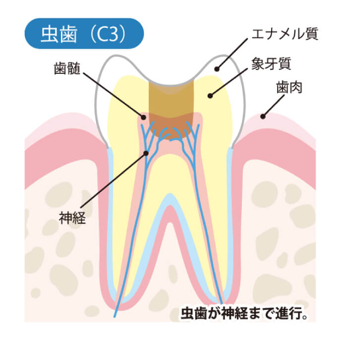 虫歯（C3）虫歯が神経まで進行。