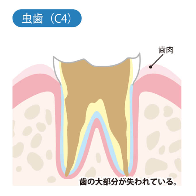 虫歯（C4）歯の大部分が失われている。